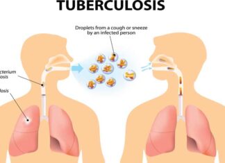 A LIFE CHANGING DISEASE CALLED TB (TUBERCULOSIS)